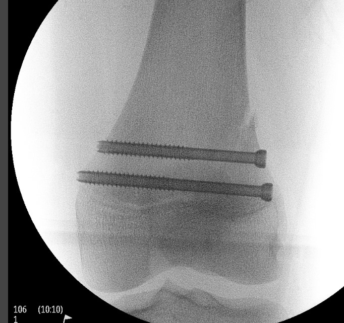 Distal Femur SH2 ORIF